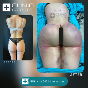 BBL after before picture brazilian butt lift