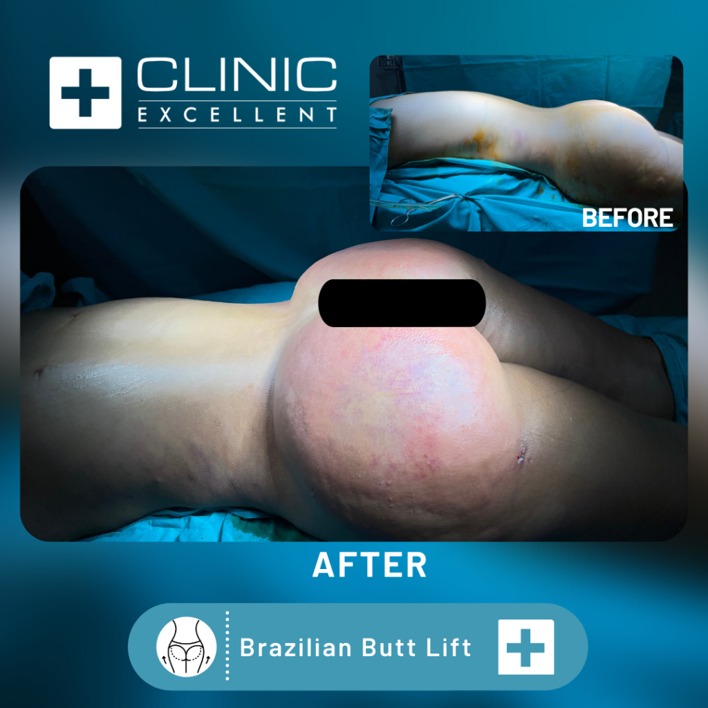 Brazilian butt lift before after