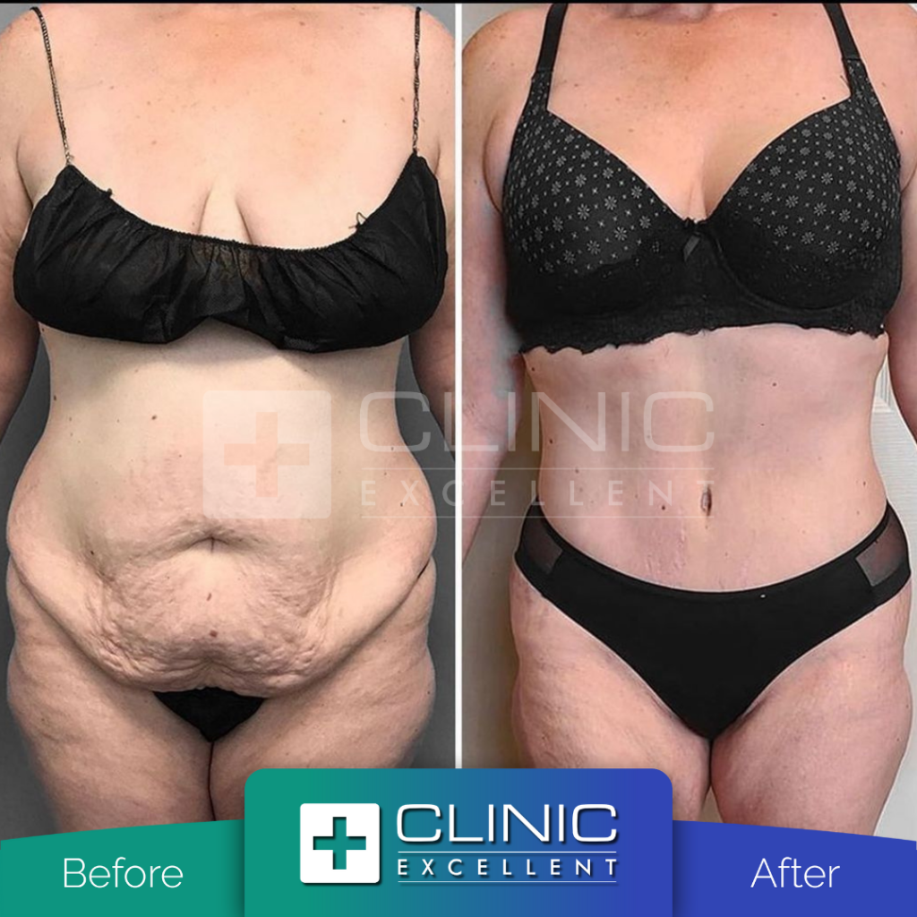 tummy tuck lipo before and after