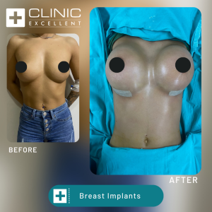 all inclusive breast lift implant